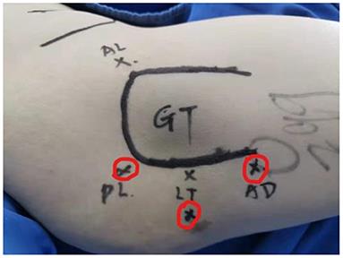 Arthroscopic Lesser Trochanter Osteoplasty, Quadratus Femoris Debridement, and Sciatic Neurolysis via Posterior Approach for Ischiofemoral Impingement